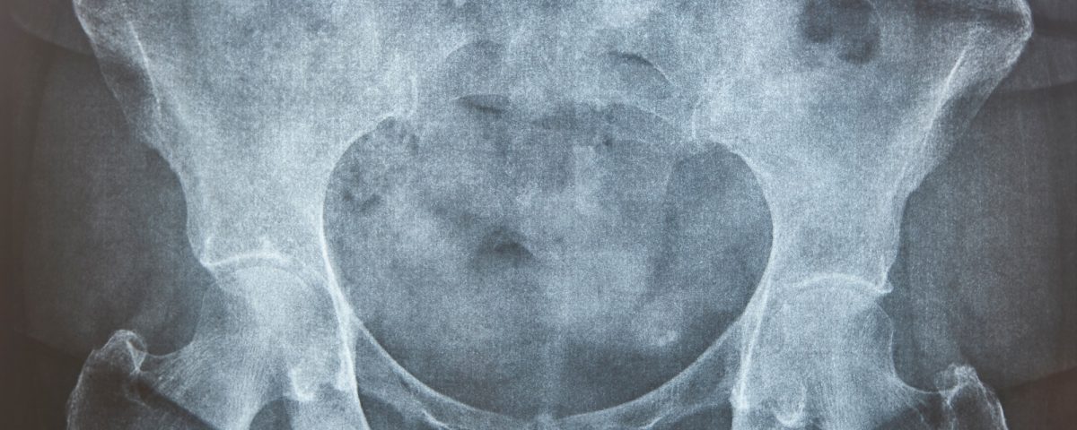 Hip xray. Human skeleton. Pelvis and femur bone. Osteoporosis