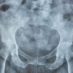 Hip xray. Human skeleton. Pelvis and femur bone. Osteoporosis