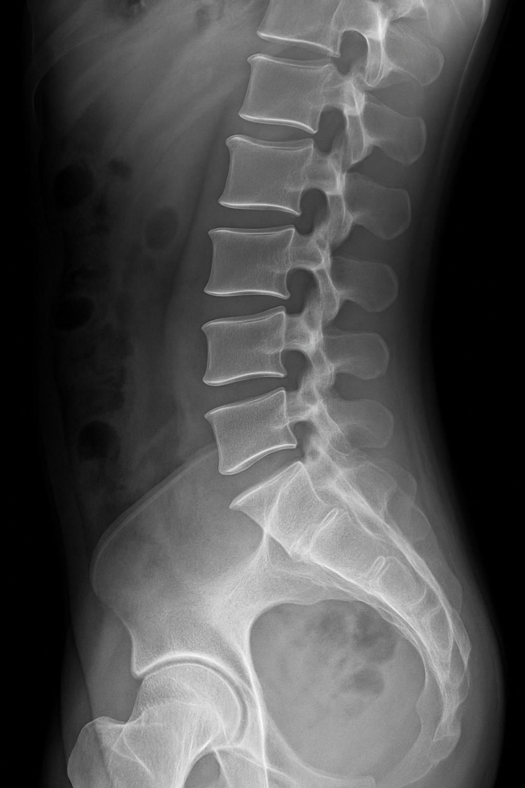 découvrez les dernières avancées technologiques en décompression neurovertébrale et leur influence positive sur la performance et la récupération dans le domaine sportif.